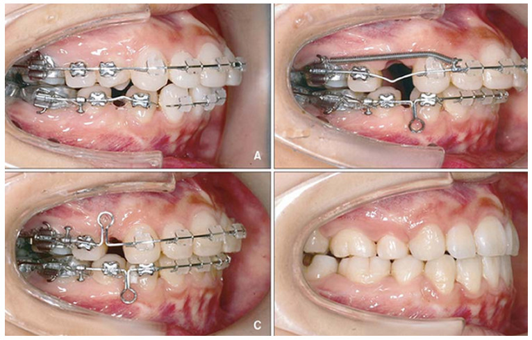 Bạn nên niềng răng khi răng bị thưa, hô hay mọc lệch lạc