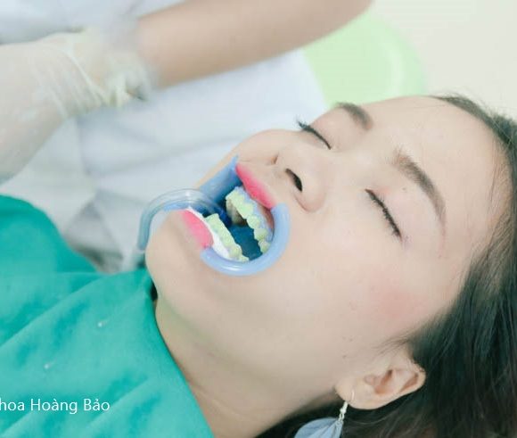 Cách tẩy trắng răng an toàn và hiệu quả nhất?