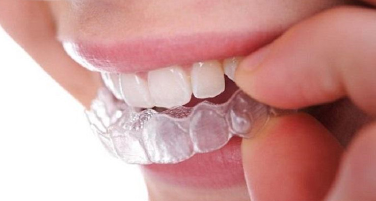 Có nên tẩy trắng răng tại nhà?