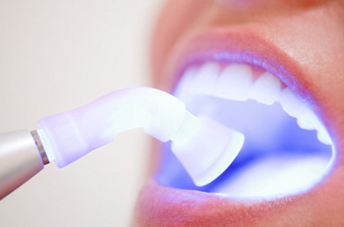 Tẩy trắng răng tại phòng khám uy tín