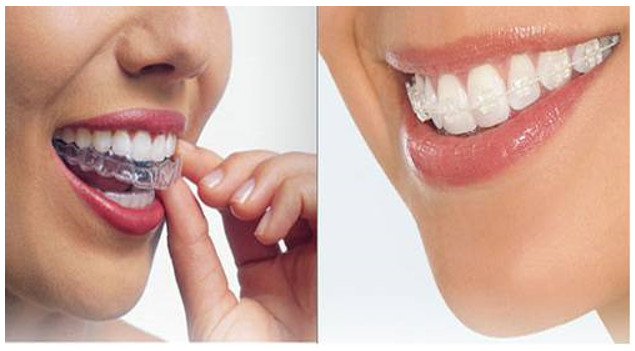 Thời gian niềng răng kéo dài trên dưới 4 năm tùy thuộc phương pháp