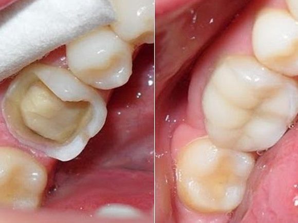 Giải đáp thắc mắc: Trám răng có đau không ?