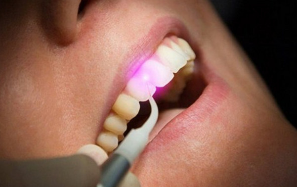 Công nghệ trám răng laser tech hiện đại nhất hiện nay