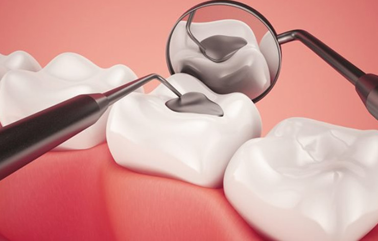 Đơn vị trám răng uy tín phải đảm bảo làm việc đúng theo quy trình của bộ y tế đưa ra