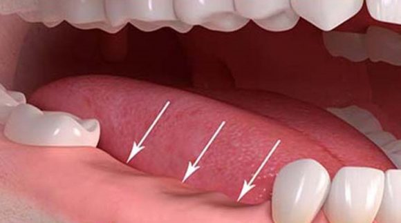 Điều trị rối loạn thoái dương hàm bằng phương pháp nhổ răng