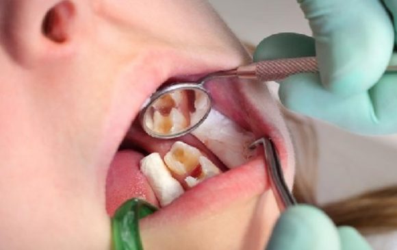 Điều trị bệnh viêm tủy răng cần phải làm đúng theo quy trình