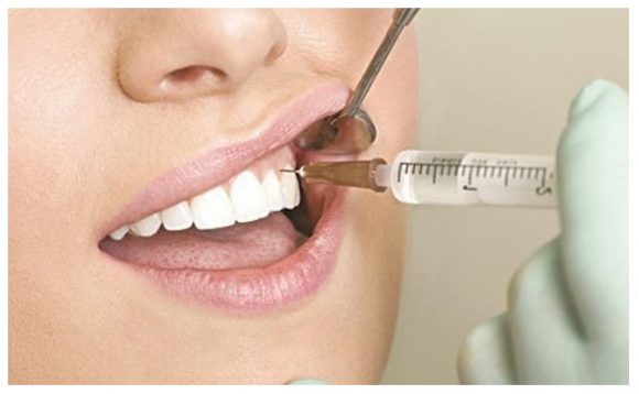 Các bác sĩ tiến hành khoan lỗ trên răng để hút tủy ra