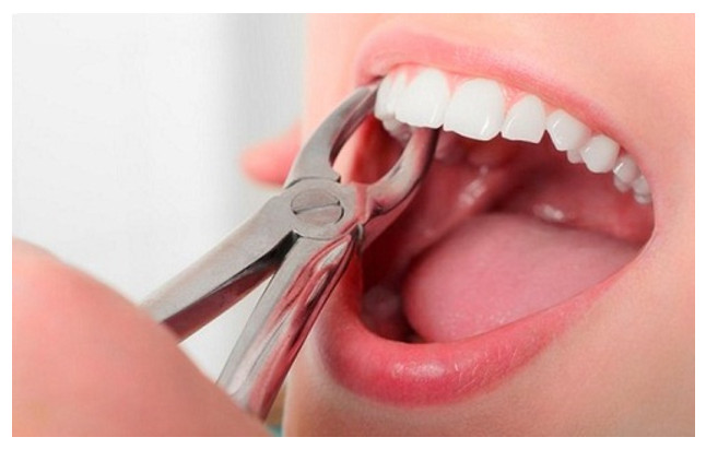 Nhổ răng bao nhiêu tiền và khi nào nên đi nhổ răng?