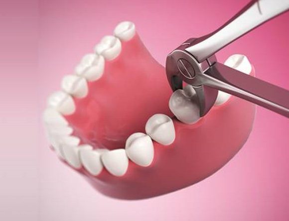 Tìm hiểu tất cả thông tin về nhổ răng hàm