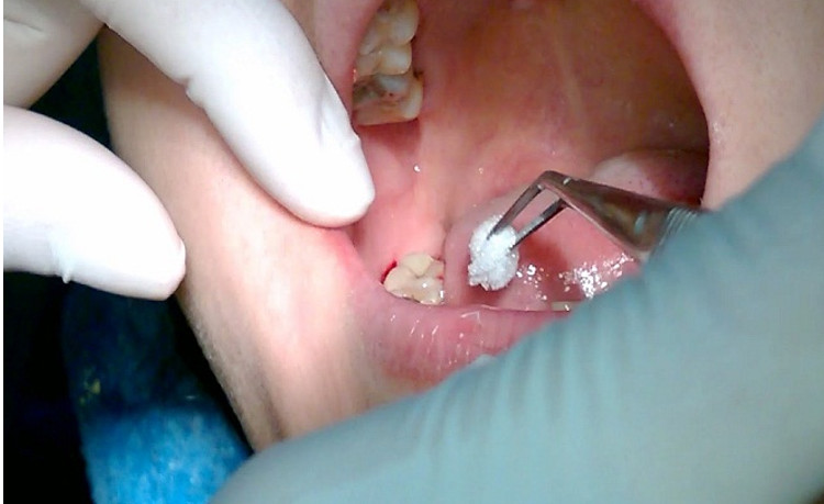 Nhổ răng hàm dưới tại các trung tâm y tế chuyên nghiệp bạn sẽ không gặp ảnh hưởng gì