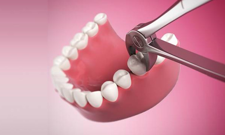 Việc nhổ đi chiếc răng hàm khi vừa bị lung lay có nên hay không?