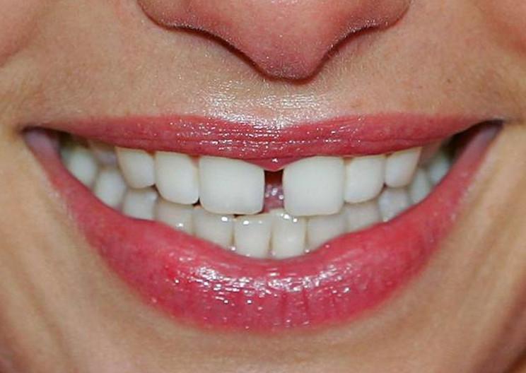 Niềng răng trị răng thưa đang là phương pháp rất phổ biến