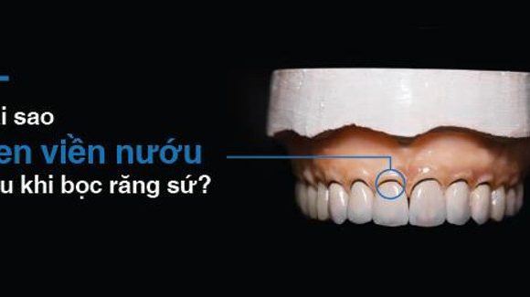 Răng sứ bị đen viền nướu – Tại sao và khắc phục bằng cách nào ?