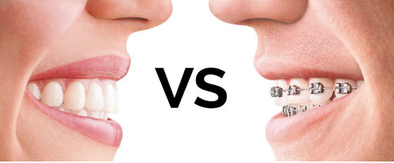 Niềng răng 3D Clear – Giải pháp thẩm mỹ hiệu quả dành cho bạn
