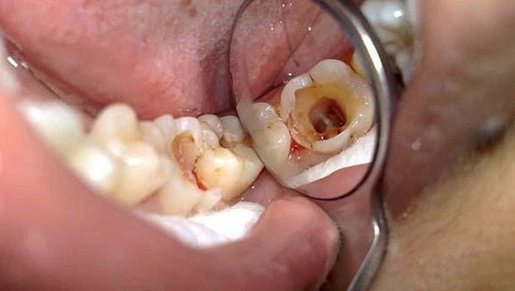 Tại sao cần phải điều trị viêm tủy răng?