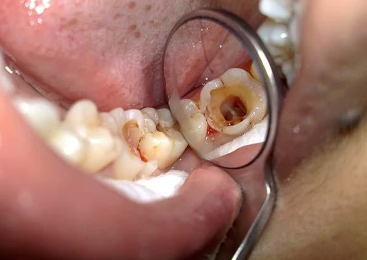 Sâu răng gây nhiều cơn đau cho bạn