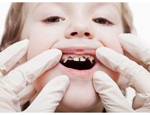 Một số cách điều trị tủy răng sữa khoa học