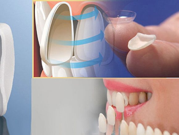 Phương pháp thẩm mỹ dán răng sứ Veneer có tốt không?