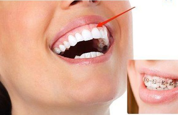 Niềng răng xong bị hở lợi, nguyên nhân và giải pháp khắc phục.