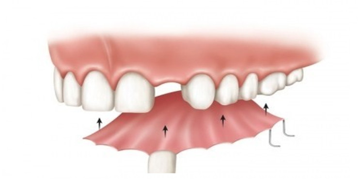Răng giả tháo lắp 1 răng bằng nhựa dẻo có giá thành hợp lý nhưng độ bền không cao.