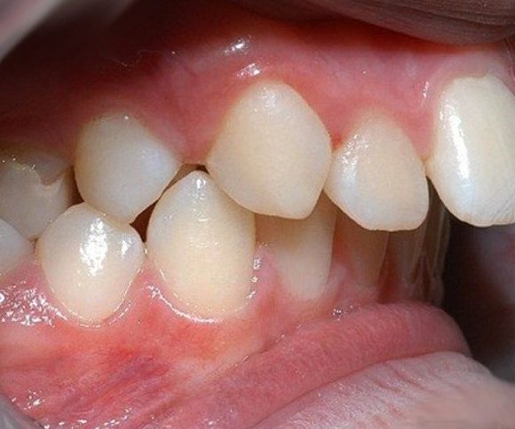 Răng hô – Nguyên nhân và cách chữa răng hô nhanh và hiệu quả nhất