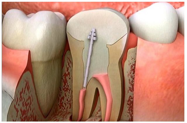 Các bước điều trị tủy răng diễn ra như thế nào?