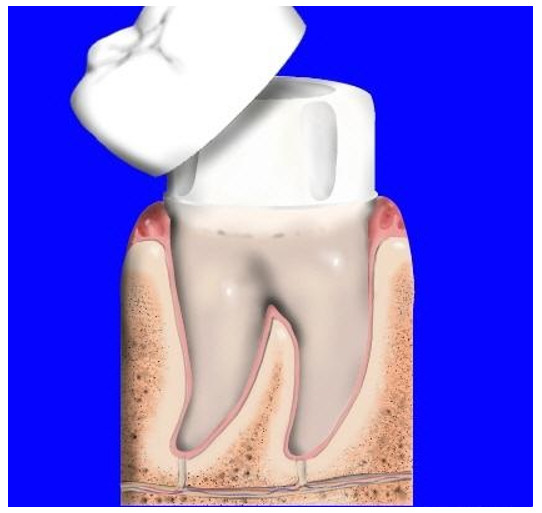 Răng sứ bị mẻ có thể hàn được nếu không sứt mẻ quá nặng