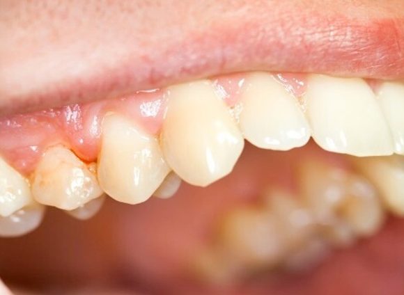 Nguyên nhân và cách chữa sưng lợi răng hàm hiệu quả, an toàn