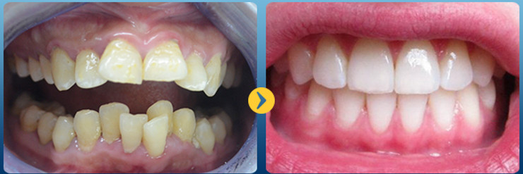 Hình ảnh trước và sau khi chửa răng vẩu
