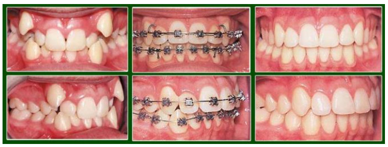 Hình ảnh trước và sau khi niềng răng khểnh
