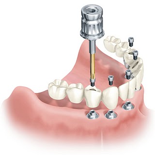 Type-of-Implant-implantology