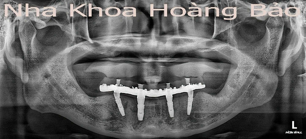 4 cây implant trên 1 hàm tồn tại bao lâu?