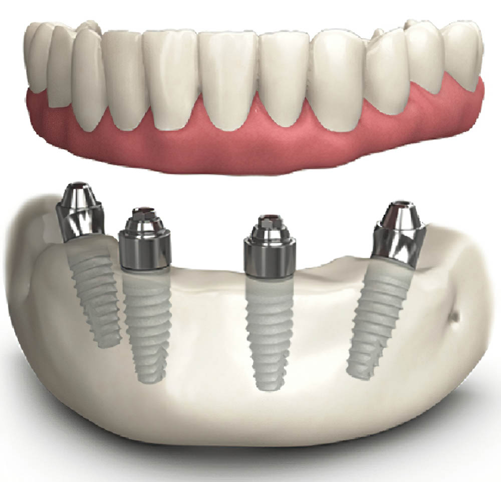 Phục hình răng giả trên 4 trụ implant