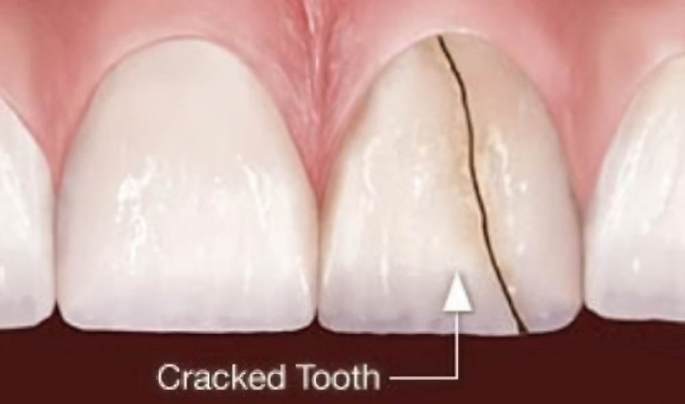 Răng bị sứt mẻ hoặc nứt